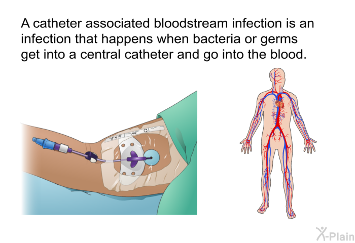 A catheter associated bloodstream infection is an infection that happens when bacteria or germs get into a central catheter and go into the blood.