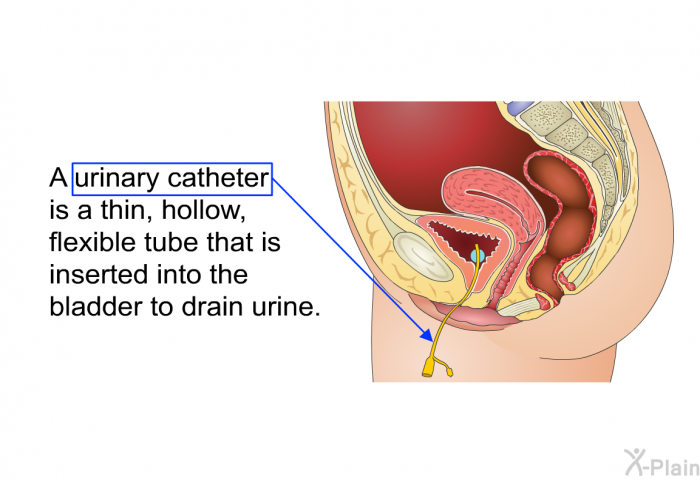 A urinary catheter is a thin, hollow, flexible tube that is inserted into the bladder to drain urine.