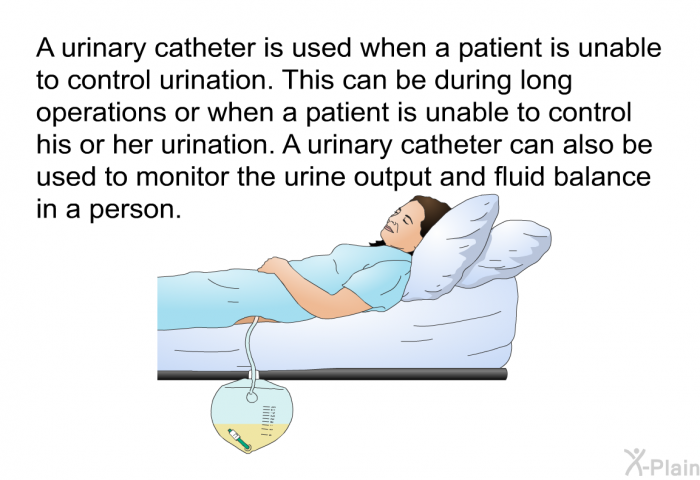 A urinary catheter is used when a patient is unable to control urination. This can be during long operations or when a patient is unable to control his or her urination. A urinary catheter can also be used to monitor the urine output and fluid balance in a person.