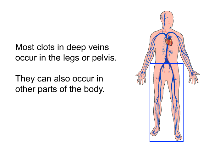 Most clots in deep veins occur in the legs or pelvis. They can also occur in other parts of the body.
