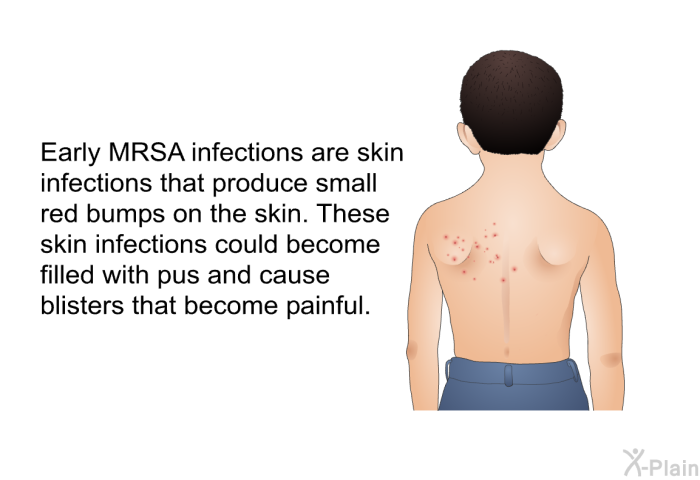 Early MRSA infections are skin infections that produce small red bumps on the skin. These skin infections could become filled with pus and cause blisters that become painful.