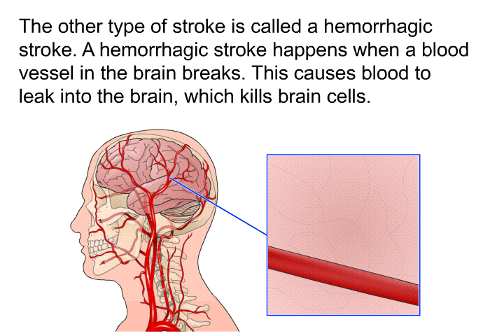 The other type of stroke is called a hemorrhagic stroke. A hemorrhagic stroke happens when a blood vessel in the brain breaks. This causes blood to leak into the brain, which kills brain cells.