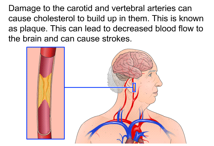 Damage to the carotid and vertebral arteries can cause cholesterol to build up in them. This is known as plaque. This can lead to decreased blood flow to the brain and can cause strokes.