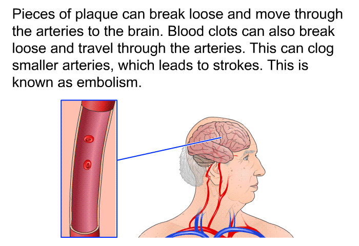 Pieces of plaque can break loose and move through the arteries to the brain. Blood clots can also break loose and travel through the arteries. This can clog smaller arteries, which leads to strokes. This is known as embolism.
