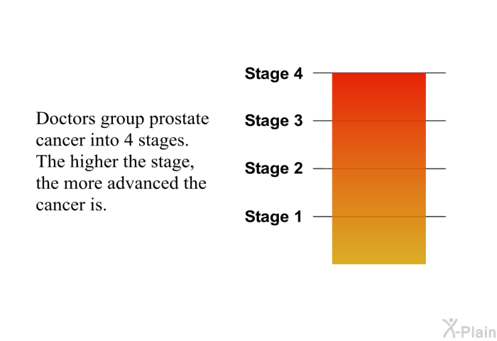 Doctors group prostate cancer into 4 stages. The higher the stage, the more advanced the cancer is.