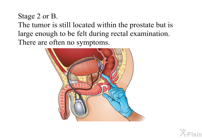 Stage 2 or B. The tumor is still located within the prostate but is large enough to be felt during rectal examination. There are often no symptoms.