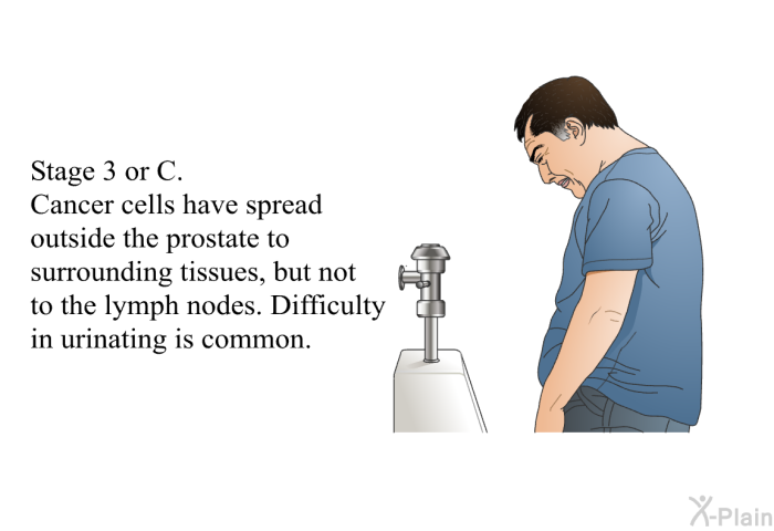 Stage 3 or C. Cancer cells have spread outside the prostate to surrounding tissues, but not to the lymph nodes. Difficulty in urinating is common.