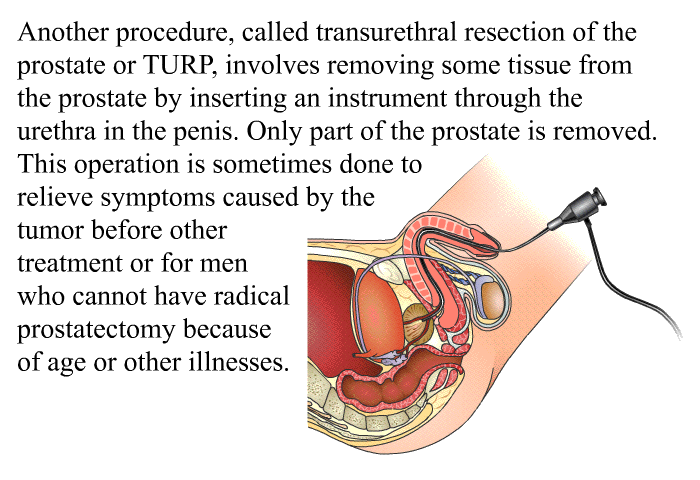 Another procedure, called transurethral resection of the prostate or TURP, involves removing some tissue from the prostate by inserting an instrument through the urethra in the penis. Only part of the prostate is removed. This operation is sometimes done to relieve symptoms caused by the tumor before other treatment or for men who cannot have radical prostatectomy because of age or other illnesses.