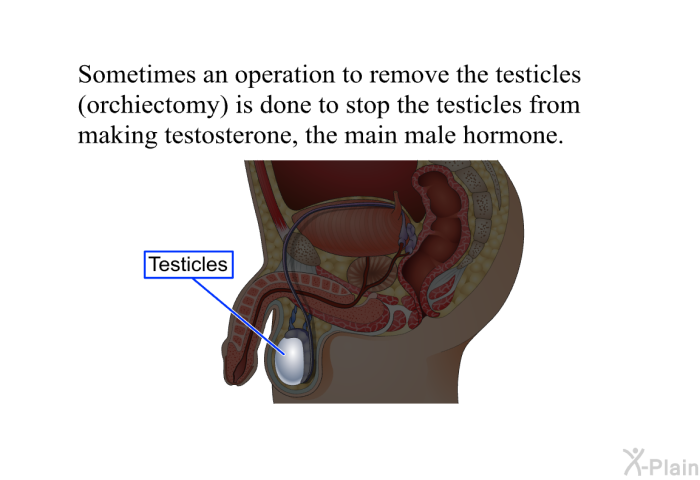 Sometimes an operation to remove the testicles (orchiectomy) is done to stop the testicles from making testosterone, the main male hormone.