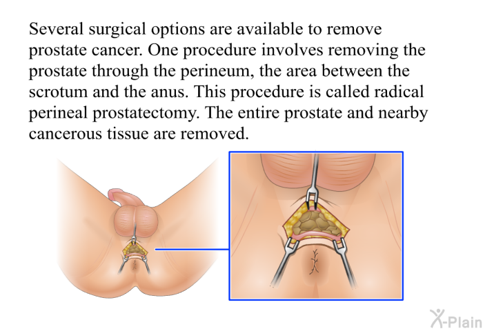 Several surgical options are available to remove prostate cancer. One procedure involves removing the prostate through the perineum, the area between the scrotum and the anus. This procedure is called radical perineal prostatectomy. The entire prostate and nearby cancerous tissue are removed.