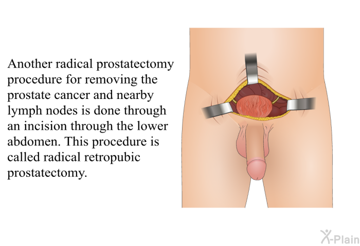Another radical prostatectomy procedure for removing the prostate cancer and nearby lymph nodes is done through an incision through the lower abdomen. This procedure is called radical retropubic prostatectomy.