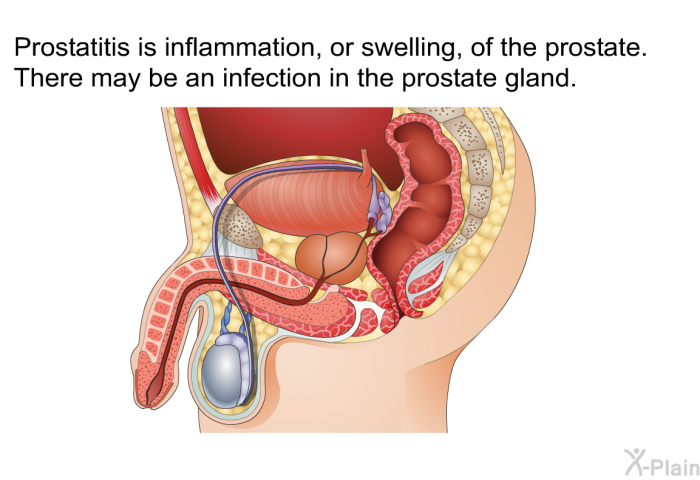 Prostatitis is inflammation, or swelling, of the prostate. There may be an infection in the prostate gland.