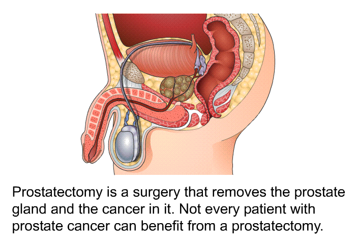 Prostatectomy is a surgery that removes the prostate gland and the cancer in it. Not every patient with prostate cancer can benefit from a prostatectomy.