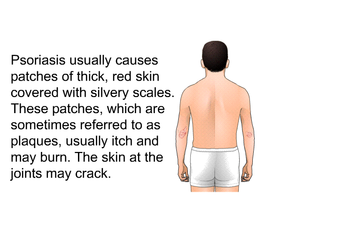 Psoriasis usually causes patches of thick, red skin covered with silvery scales. These patches, which are sometimes referred to as <I>plaques</I>, usually itch and may burn. The skin at the joints may crack.