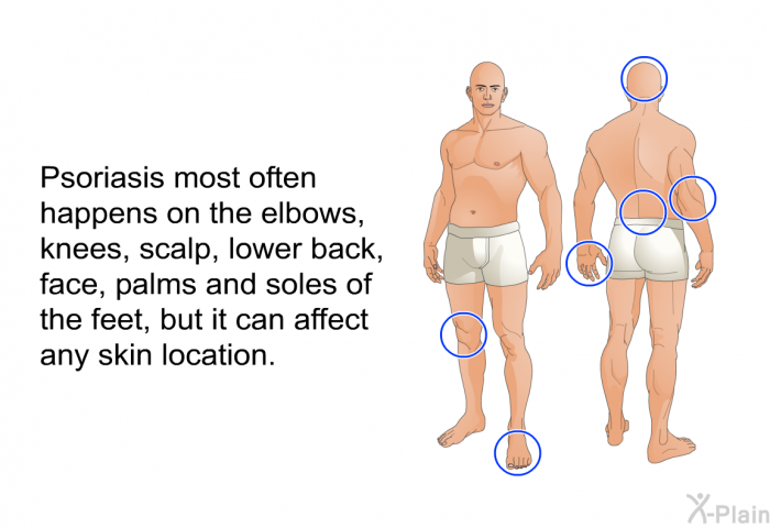 Psoriasis most often happens on the elbows, knees, scalp, lower back, face, palms and soles of the feet, but it can affect any skin location.
