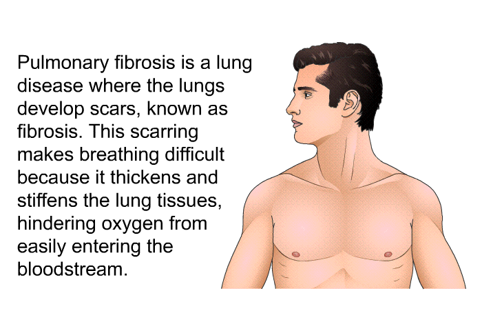 Pulmonary fibrosis is a lung disease where the lungs develop scars, known as fibrosis. This scarring makes breathing difficult because it thickens and stiffens the lung tissues, hindering oxygen from easily entering the bloodstream.