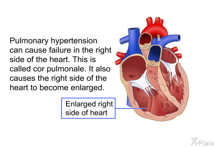 Pulmonary hypertension can cause failure in the right side of the heart. This is called cor pulmonale. It also causes the right side of the heart to become enlarged.