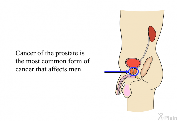 Cancer of the prostate is the most common form of cancer that affects men.