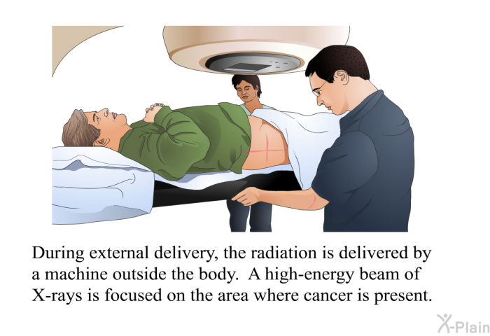 During external delivery, the radiation is delivered by a machine outside the body. A high-energy beam of X-rays is focused on the area where cancer is present.