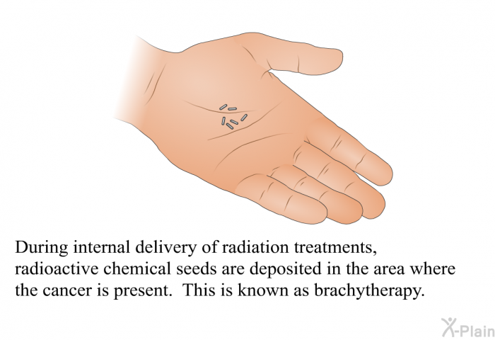 During internal delivery of radiation treatments, radioactive chemical seeds are deposited in the area where the cancer is present. This is known as brachytherapy.
