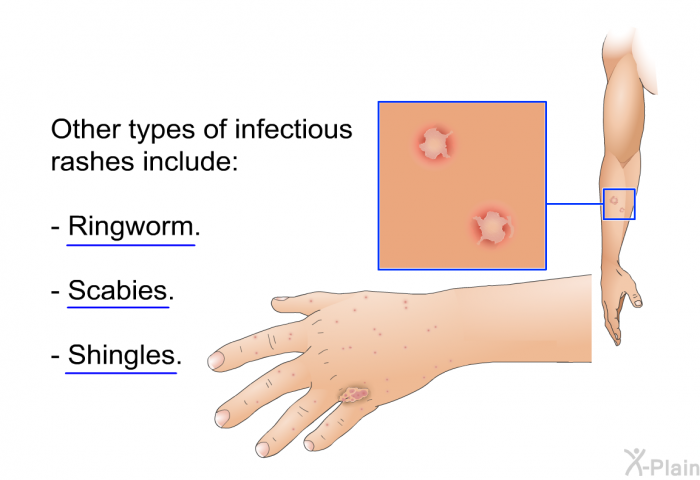 Other types of infectious rashes include:  Ringworm. Scabies. Shingles.