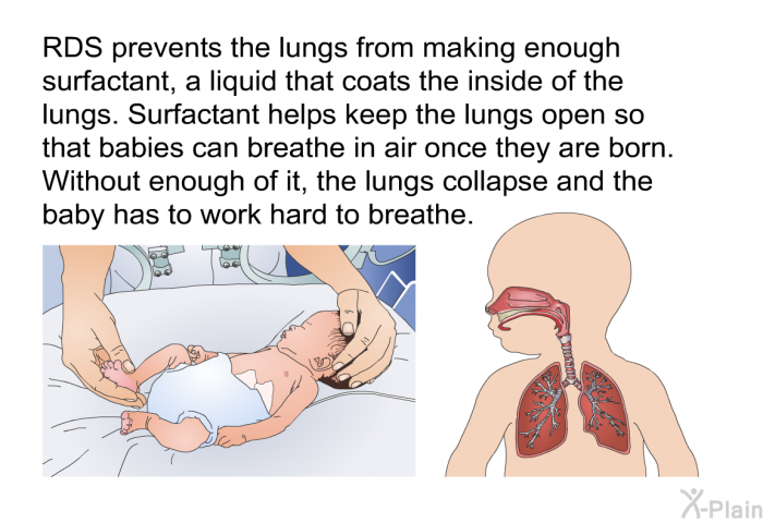 RDS prevents the lungs from making enough surfactant, a liquid that coats the inside of the lungs. Surfactant helps keep the lungs open so that babies can breathe in air once they are born. Without enough of it, the lungs collapse and the baby has to work hard to breathe.