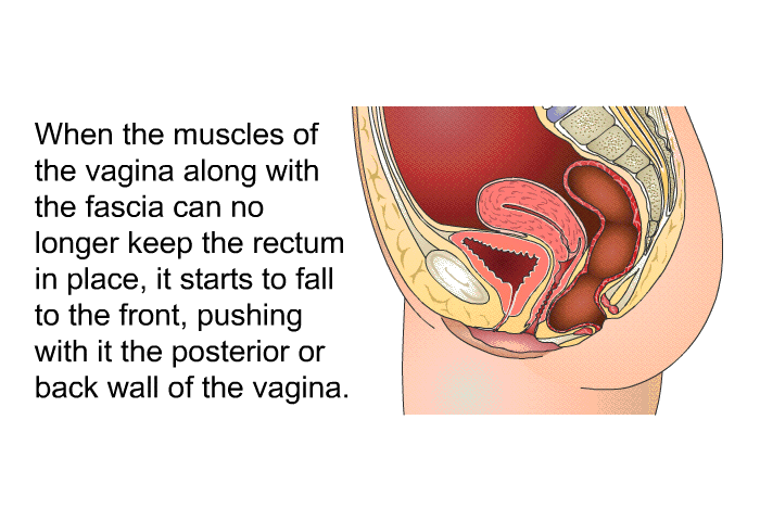 When the muscles of the vagina along with the fascia can no longer keep the rectum in place, it starts to fall to the front, pushing with it the posterior or back wall of the vagina.