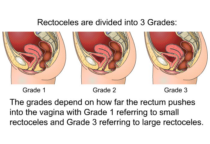 Rectoceles are divided into 3 Grades: The grades depend on how far the rectum pushes into the vagina with Grade 1 referring to small rectoceles and Grade 3 referring to large rectoceles.