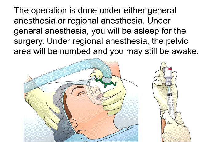 The operation is done under either general anesthesia or regional anesthesia. Under general anesthesia, you will be asleep for the surgery. Under regional anesthesia, the pelvic area will be numbed and you may still be awake.