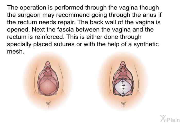 The operation is performed through the vagina though the surgeon may recommend going through the anus if the rectum needs repair. The back wall of the vagina is opened. Next the fascia between the vagina and the rectum is reinforced. This is either done through specially placed sutures or with the help of a synthetic mesh.