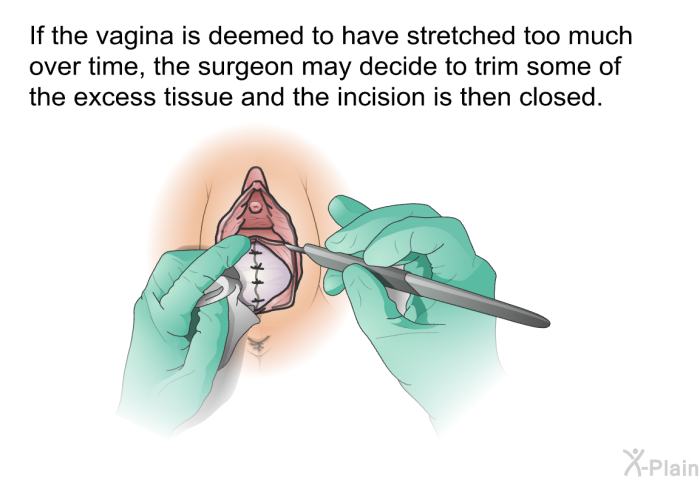 If the vagina is deemed to have stretched too much over time, the surgeon may decide to trim some of the excess tissue and the incision is then closed.