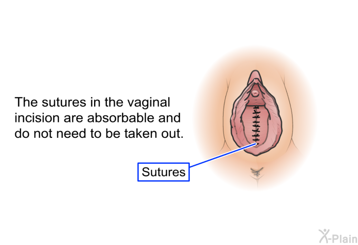 The sutures in the vaginal incision are absorbable and do not need to be taken out.