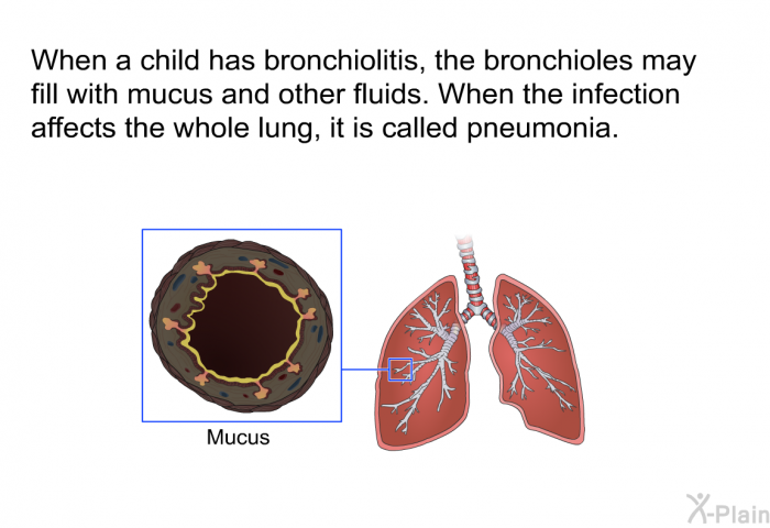 When a child has bronchiolitis, the bronchioles may fill with mucus and other fluids. When the infection affects the whole lung, it is called pneumonia.