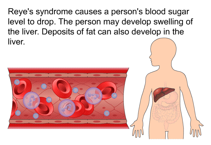 Reye's syndrome causes a person's blood sugar level to drop. The person may develop swelling of the liver. Deposits of fat can also develop in the liver.