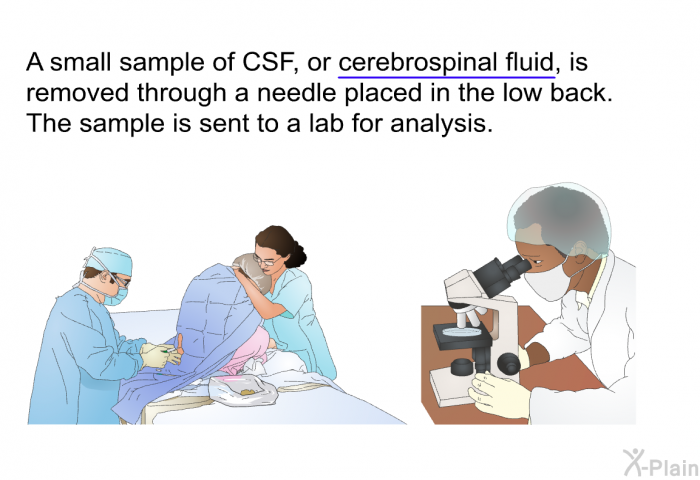 A small sample of CSF, or cerebrospinal fluid, is removed through a needle placed in the low back. The sample is sent to a lab for analysis.