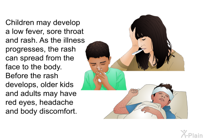 Children may develop a low fever, sore throat and rash. As the illness progresses, the rash can spread from the face to the body. Before the rash develops, older kids and adults may have red eyes, headache and body discomfort.