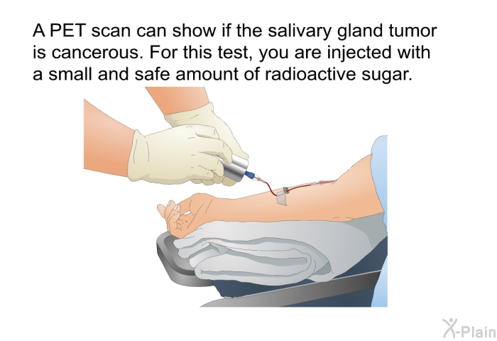 A PET scan can show if the salivary gland tumor is cancerous. For this test, you are injected with a small and safe amount of radioactive sugar.