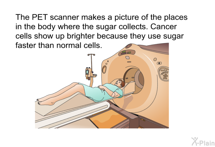 The PET scanner makes a picture of the places in the body where the sugar collects. Cancer cells show up brighter because they use sugar faster than normal cells.