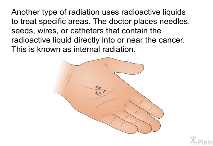 Another type of radiation uses radioactive liquids to treat specific areas. The doctor places needles, seeds, wires, or catheters that contain the radioactive liquid directly into or near the cancer. This is known as internal radiation.