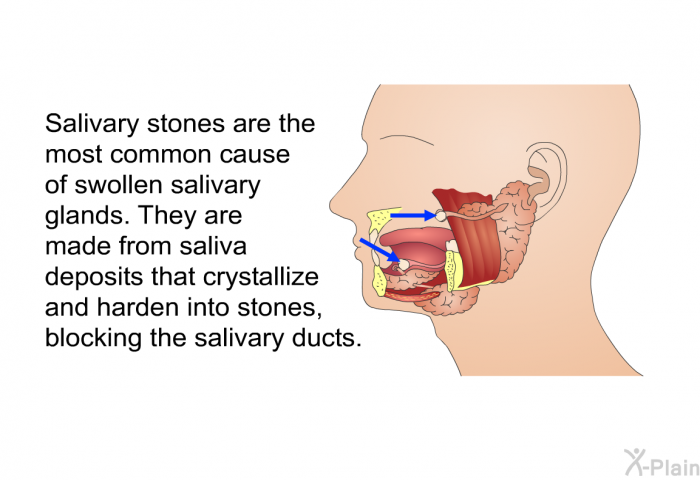 Salivary stones are the most common cause of swollen salivary glands. They are made from saliva deposits that crystallize and harden into stones, blocking the salivary ducts.