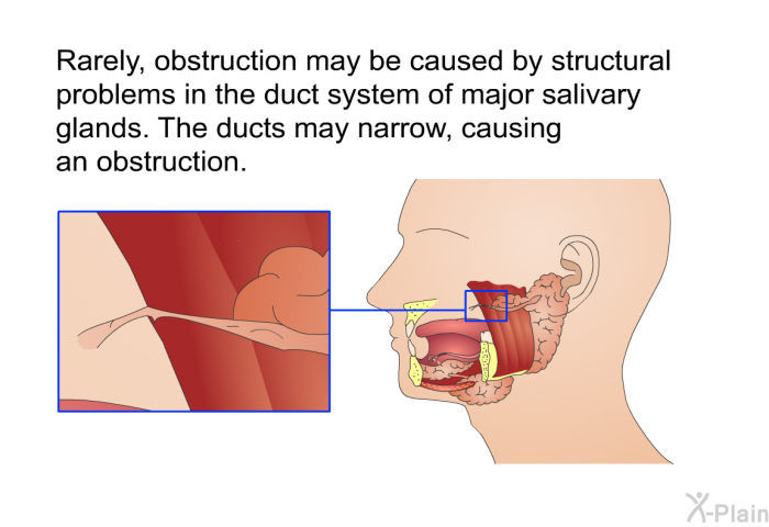 Rarely, obstruction may be caused by structural problems in the duct system of major salivary glands. The ducts may narrow, causing an obstruction.