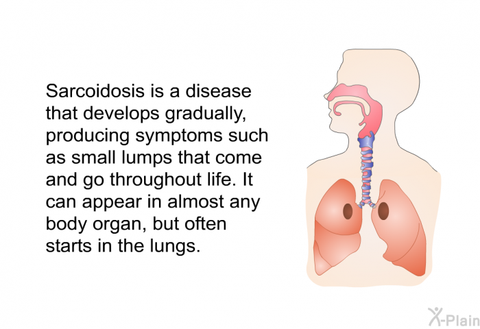Sarcoidosis is a disease that develops gradually, producing symptoms such as small lumps that come and go throughout life. It can appear in almost any body organ, but often starts in the lungs.