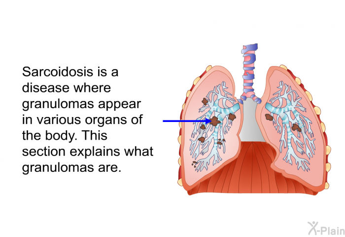 Sarcoidosis is a disease where granulomas appear in various organs of the body. This section explains what granulomas are.