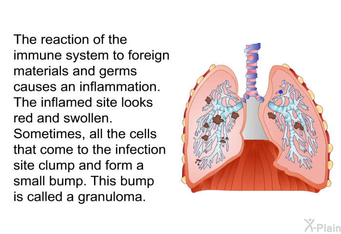 The reaction of the immune system to foreign materials and germs causes an inflammation. The inflamed site looks red and swollen. Sometimes, all the cells that come to the infection site clump and form a small bump. This bump is called a granuloma.