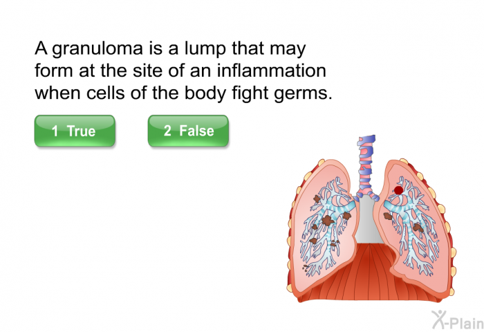 A granuloma is a lump that may form at the site of an inflammation when cells of the body fight germs.