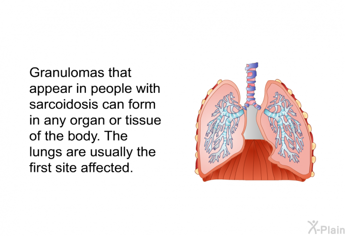 Granulomas that appear in people with sarcoidosis can form in any organ or tissue of the body. The lungs are usually the first site affected.