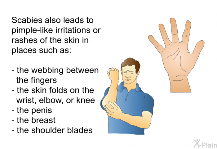 Scabies also leads to pimple-like irritations or rashes of the skin in places such as:  the webbing between the fingers the skin folds on the wrist, elbow, or knee the penis the breast the shoulder blades