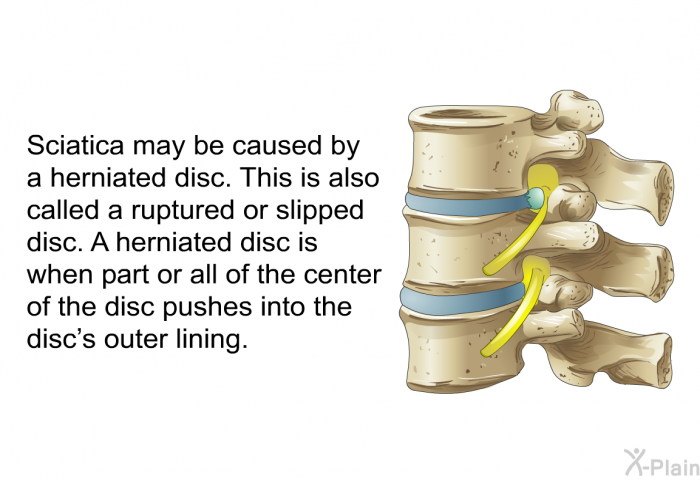 Sciatica may be caused by a herniated disc. This is also called a ruptured or slipped disc. A herniated disc is when part or all of the center of the disc pushes into the disc's outer lining.