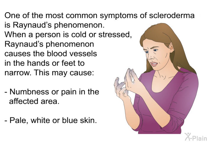 One of the most common symptoms of scleroderma is Raynaud's phenomenon. When a person is cold or stressed, Raynaud's phenomenon causes the blood vessels in the hands or feet to narrow. This may cause:  Numbness or pain in the affected area. Pale, white or blue skin.