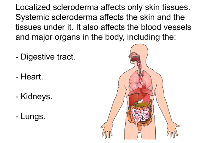 Localized scleroderma affects only skin tissues. Systemic scleroderma affects the skin and the tissues under it. It also affects the blood vessels and major organs in the body, including the:  Digestive tract. Heart. Kidneys. Lungs.